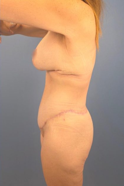 Surgery After Massive Weight Loss Before & After Patient #15939