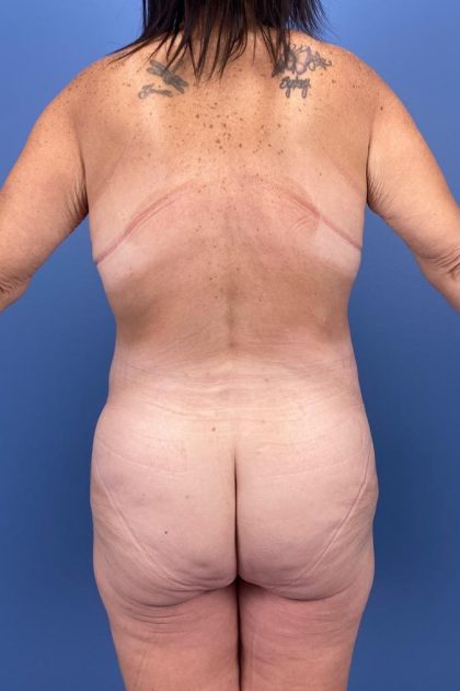 Surgery After Massive Weight Loss Before & After Patient #15939