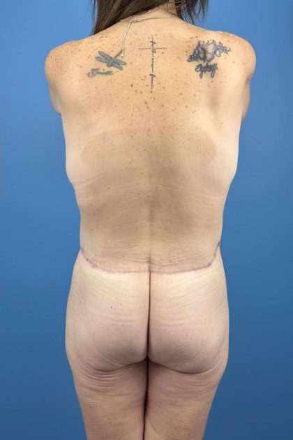 Surgery After Massive Weight Loss Before & After Patient #15939