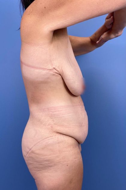 Surgery After Massive Weight Loss Before & After Patient #15939