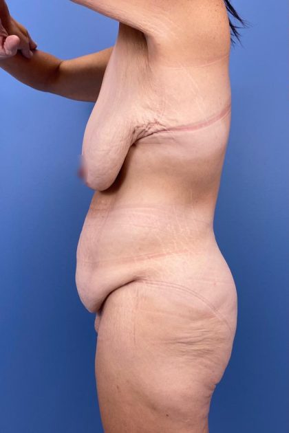 Surgery After Massive Weight Loss Before & After Patient #15939