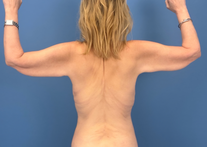 Arm Lift Before & After Patient #16006