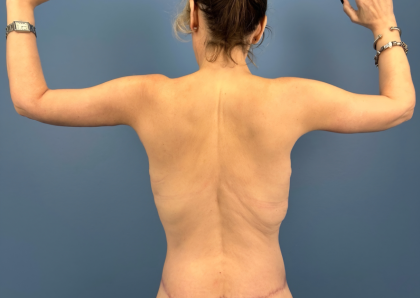 Arm Lift Before & After Patient #16006