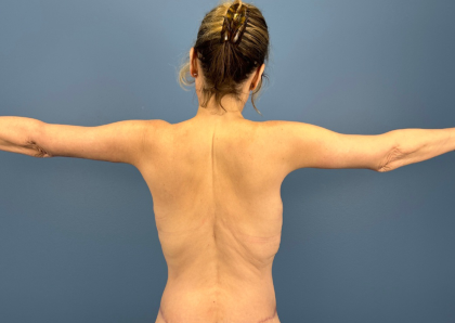 Arm Lift Before & After Patient #16006