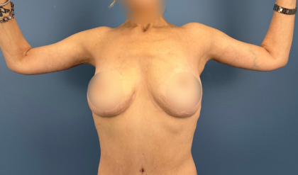 Arm Lift Before & After Patient #16006