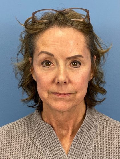 Browlift Before & After Patient #16053