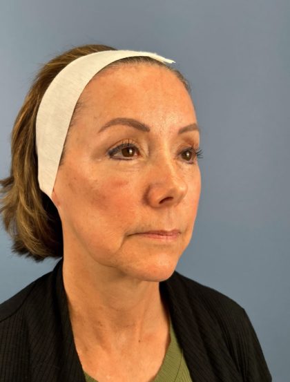 Browlift Before & After Patient #16053