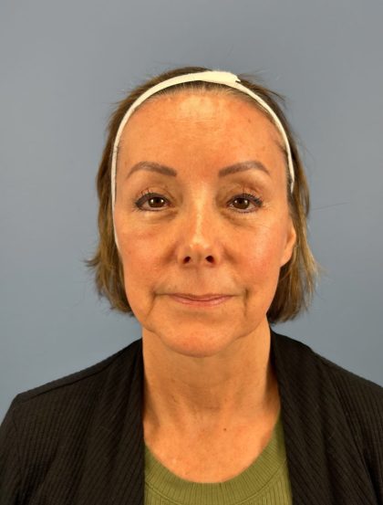 Browlift Before & After Patient #16053