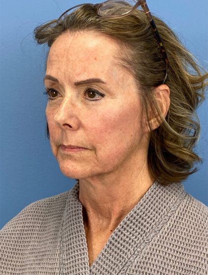 Browlift Before & After Patient #16053