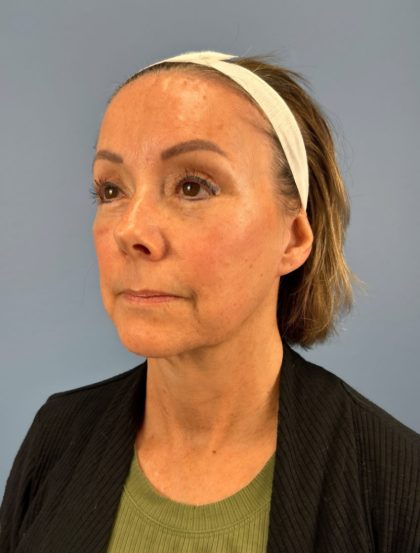 Browlift Before & After Patient #16053