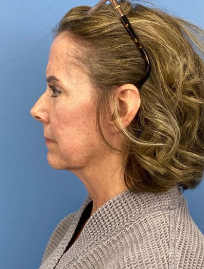 Browlift Before & After Patient #16053