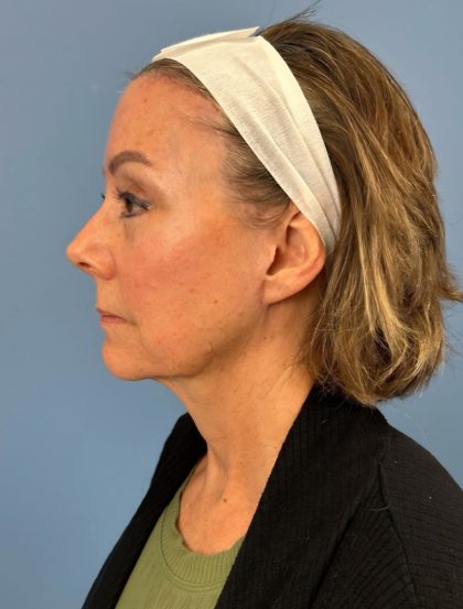 Browlift Before & After Patient #16053