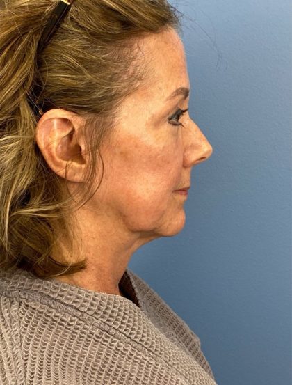 Browlift Before & After Patient #16053