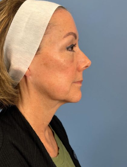 Browlift Before & After Patient #16053