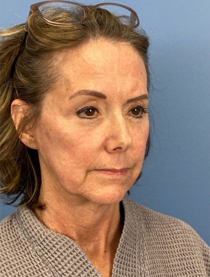 Browlift Before & After Patient #16053