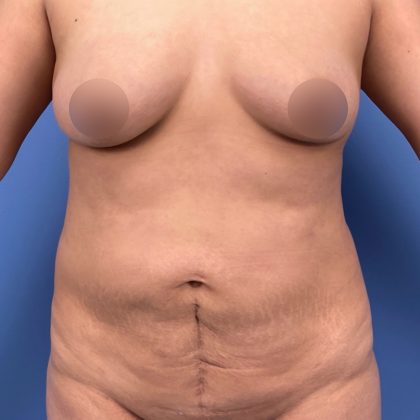 Tummy Tuck Before & After Patient #16189