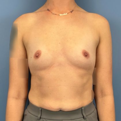 Breast Augmentation Before & After Patient #16142