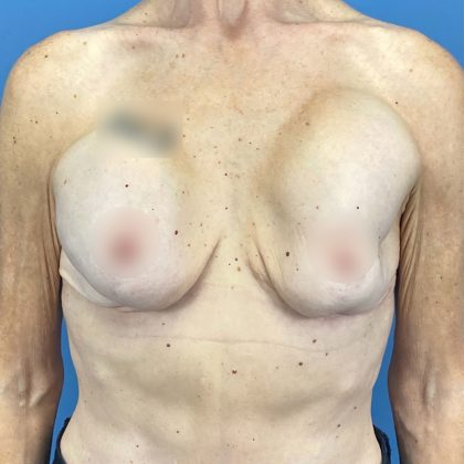 Breast Implant Removal Before & After Patient #16224