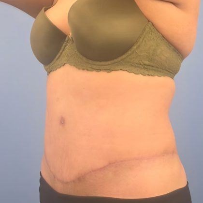 Tummy Tuck Before & After Patient #16189