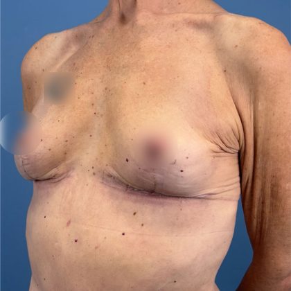 Breast Implant Removal Before & After Patient #16224