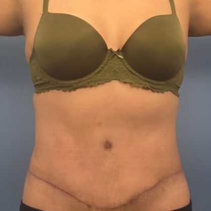 Tummy Tuck Before & After Patient #16189