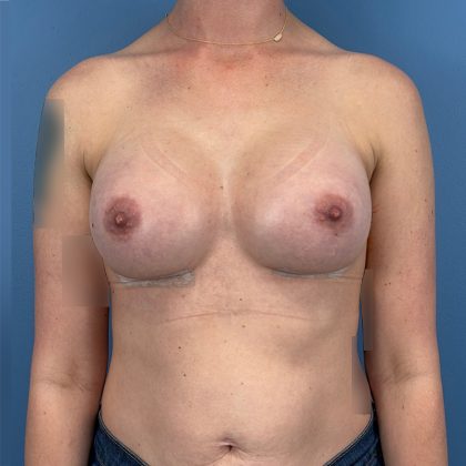 Breast Augmentation Before & After Patient #16142
