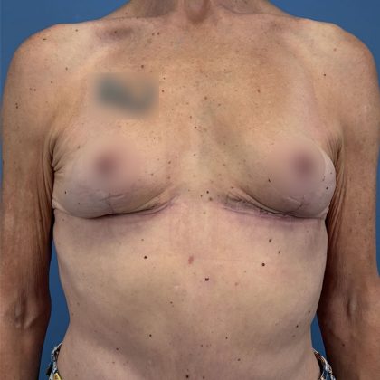 Breast Implant Removal Before & After Patient #16224