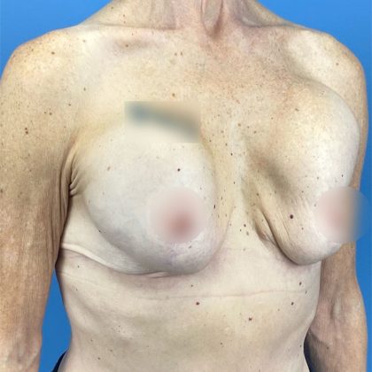Breast Implant Removal Before & After Patient #16224