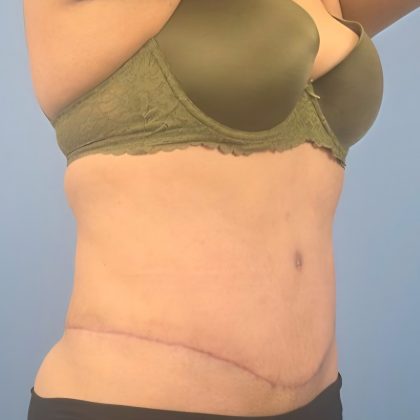 Tummy Tuck Before & After Patient #16189