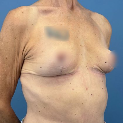 Breast Implant Removal Before & After Patient #16224