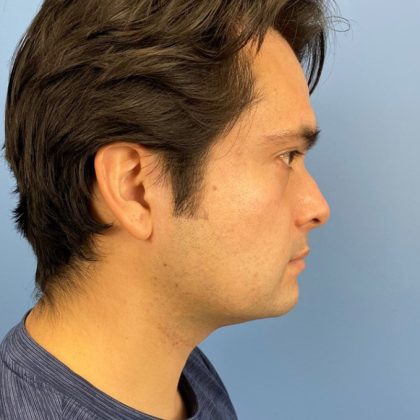 Buccal Fat Removal Before & After Patient #16153