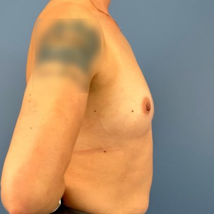 Breast Augmentation Before & After Patient #16142