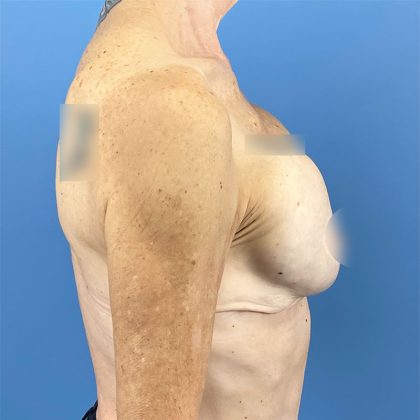 Breast Implant Removal Before & After Patient #16224