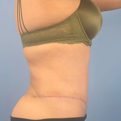 Tummy Tuck Before & After Patient #16189
