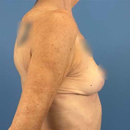 Breast Implant Removal Before & After Patient #16224