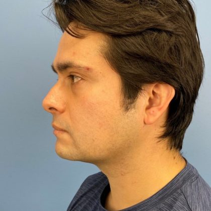 Buccal Fat Removal Before & After Patient #16153