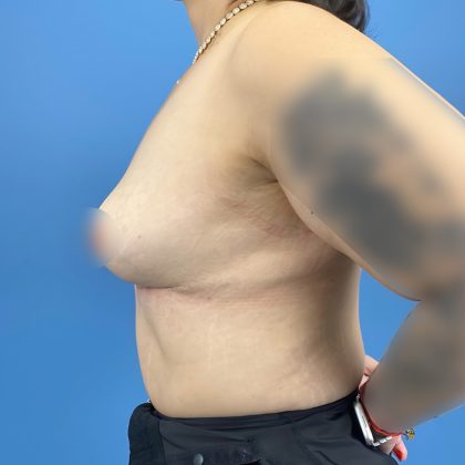 Breast Implant Removal Before & After Patient #16213
