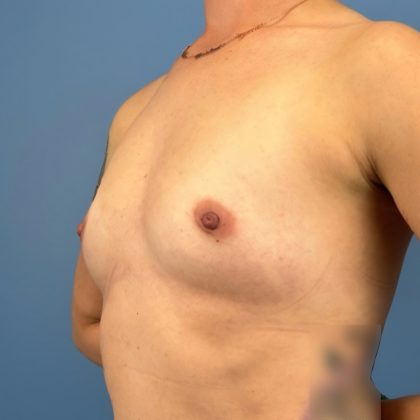 Breast Augmentation Before & After Patient #16142