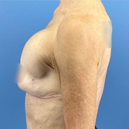 Breast Implant Removal Before & After Patient #16224