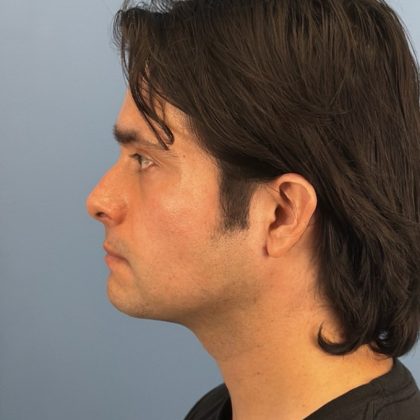 Buccal Fat Removal Before & After Patient #16153