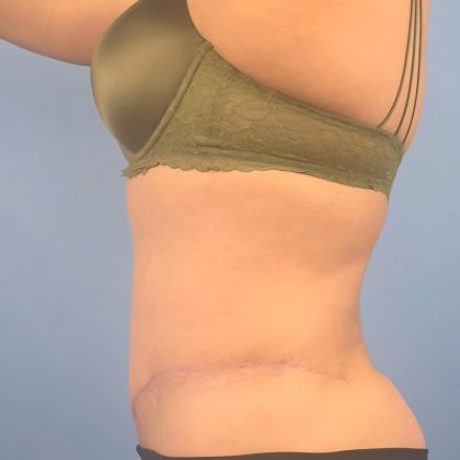 Tummy Tuck Before & After Patient #16189