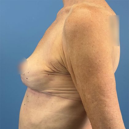 Breast Implant Removal Before & After Patient #16224