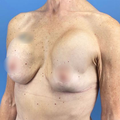 Breast Implant Removal Before & After Patient #16224