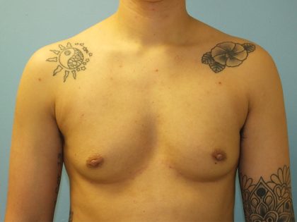Female to Male Before & After Patient #16117