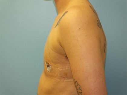 Female to Male Before & After Patient #16117