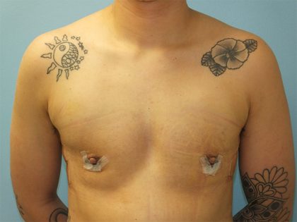 Female to Male Before & After Patient #16117