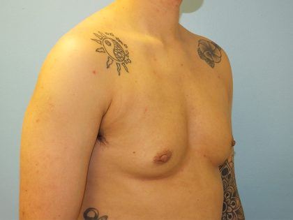 Female to Male Before & After Patient #16117