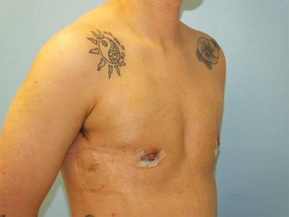 Female to Male Before & After Patient #16117