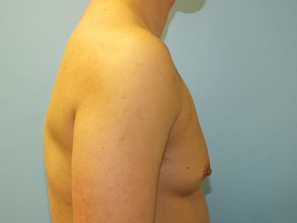 Female to Male Before & After Patient #16117