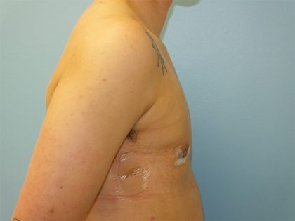 Female to Male Before & After Patient #16117